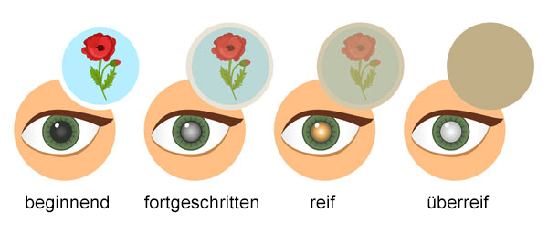 Stadien Grauer Star: beginnende Katarakt - fortgeschrittene Katarakt - reife Katarakt - überreife Katarakt